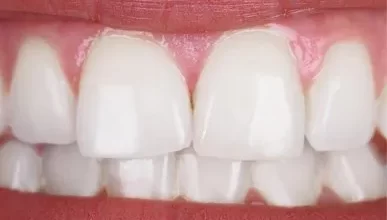Photo of Which Teeth Whitening Options Are The Most Effective?
