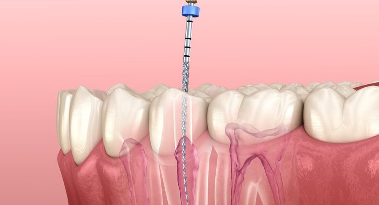 down root canal treatment